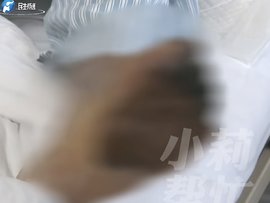 货车司机一天喝10瓶冰镇碳酸饮料 5年时间5个脚趾被截掉