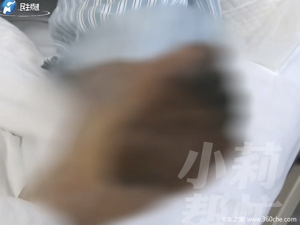 货车司机一天喝10瓶冰镇碳酸饮料 5年时间5个脚趾被截掉